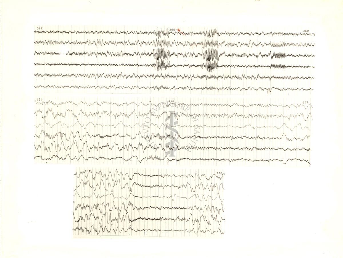 Tracciati elettroencefalografici