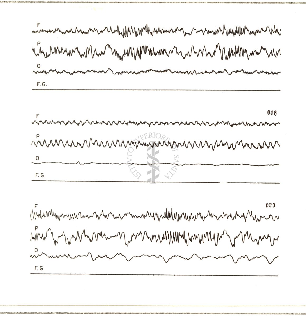 Tracciati elettroencefalografici