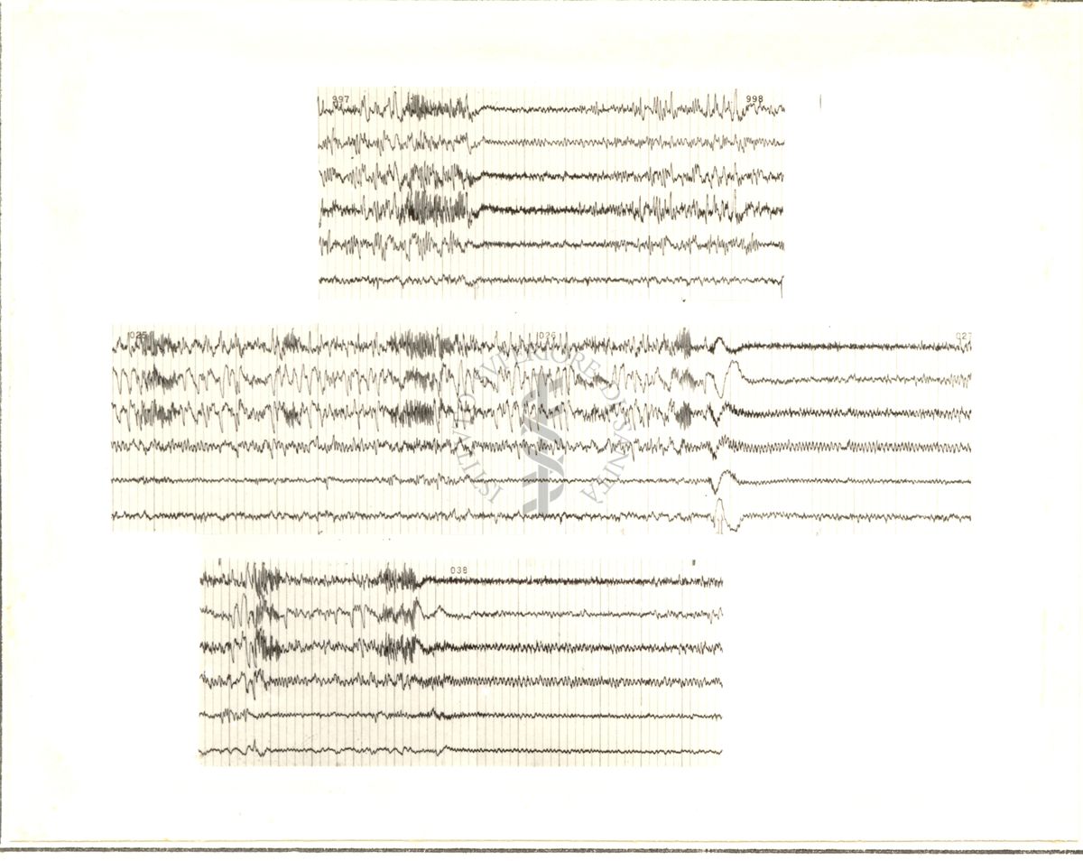 Tracciati elettroencefalografici