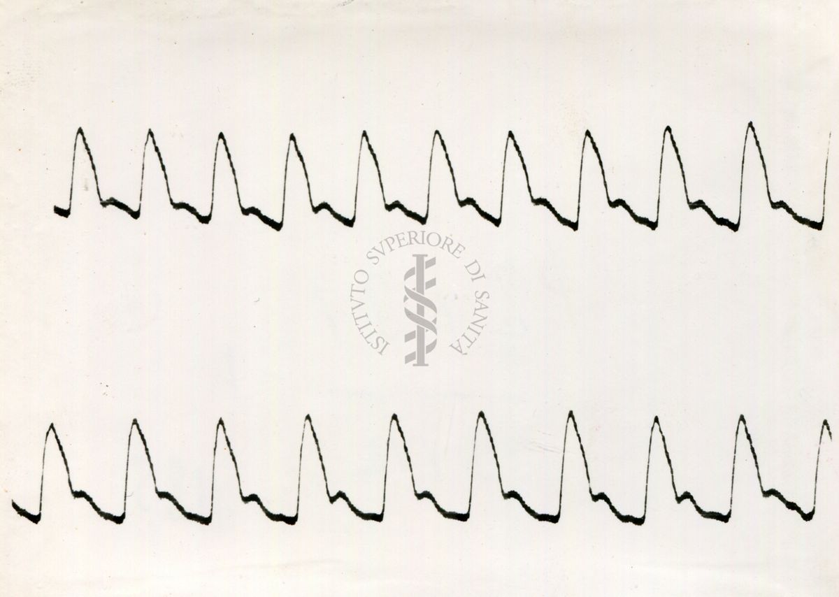 Registrazione piezografica del polso dell'arteria temporale nell'uomo sotto effetto di vari farmaci