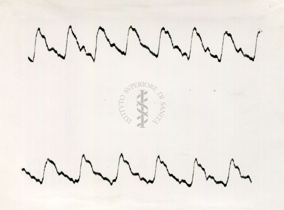 Registrazione piezografica del polso dell'arteria temporale nell'uomo sotto effetto di vari farmaci