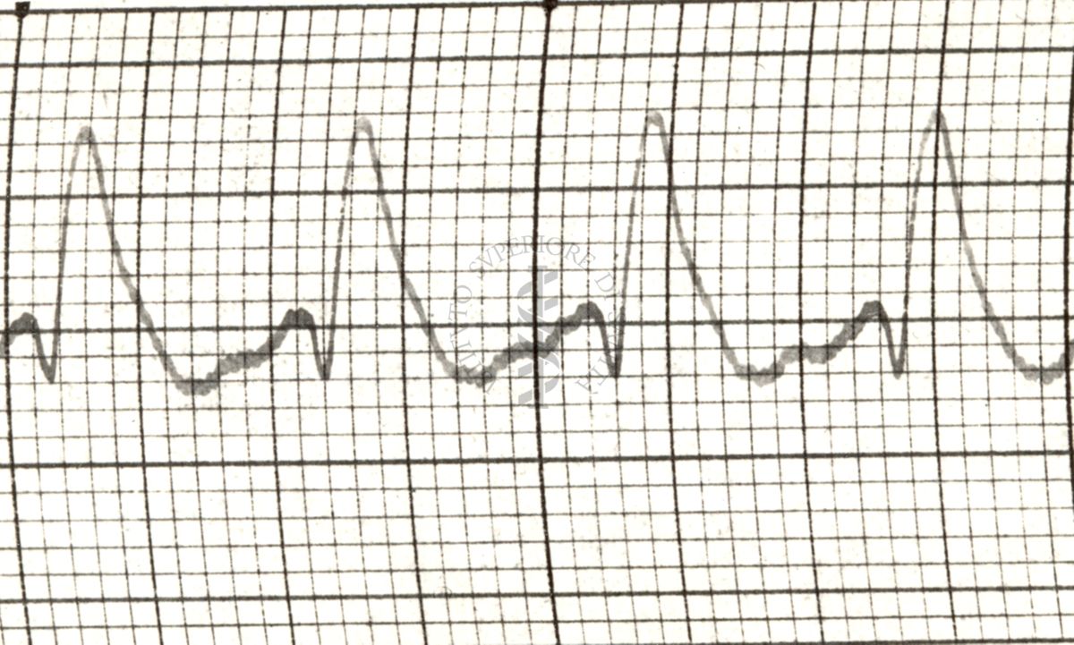 Azione del Nitrito di amile sulla arteria temporale nell'uomo