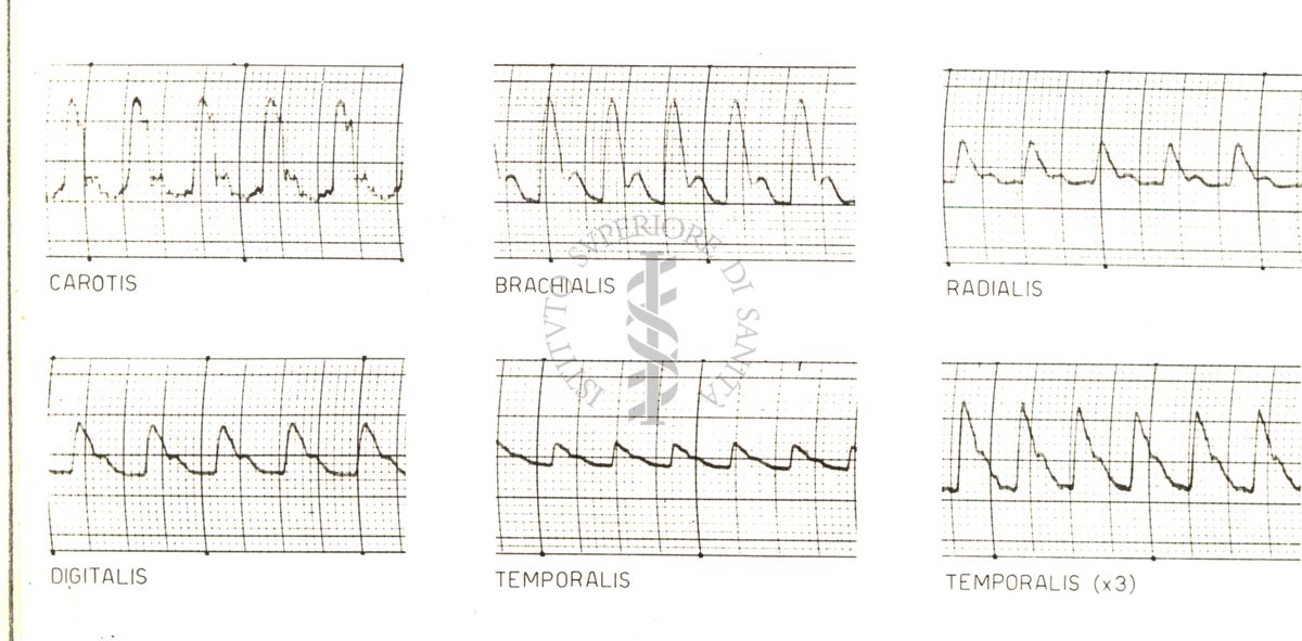 Registrazioni delle pulsazioni dell'arteria temporale nell'uomo sotto azione di vari farmaci