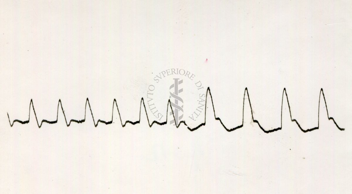 Pletismogramma dell'arteria temporale dell'uomo (azione dell'istamina)