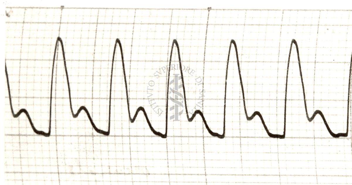 Piezosfigmogrammi delle principali arterie dell'uomo