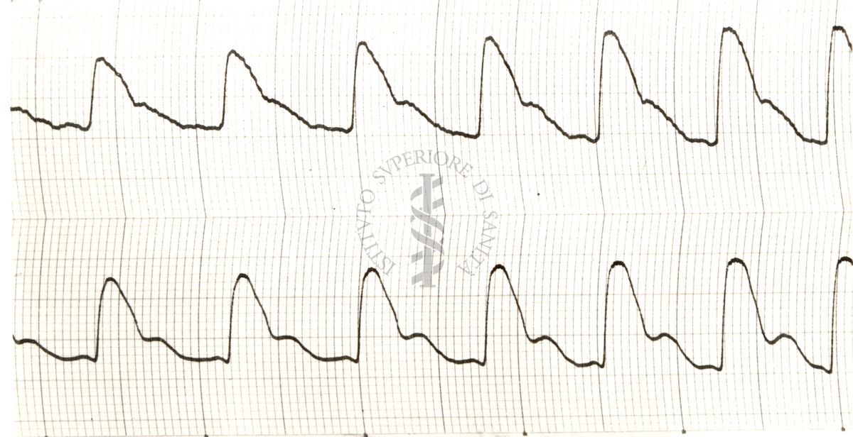 Modificazioni del piezogramma temporale nell'uomo sotto azione di istamina e di nitrito di amile