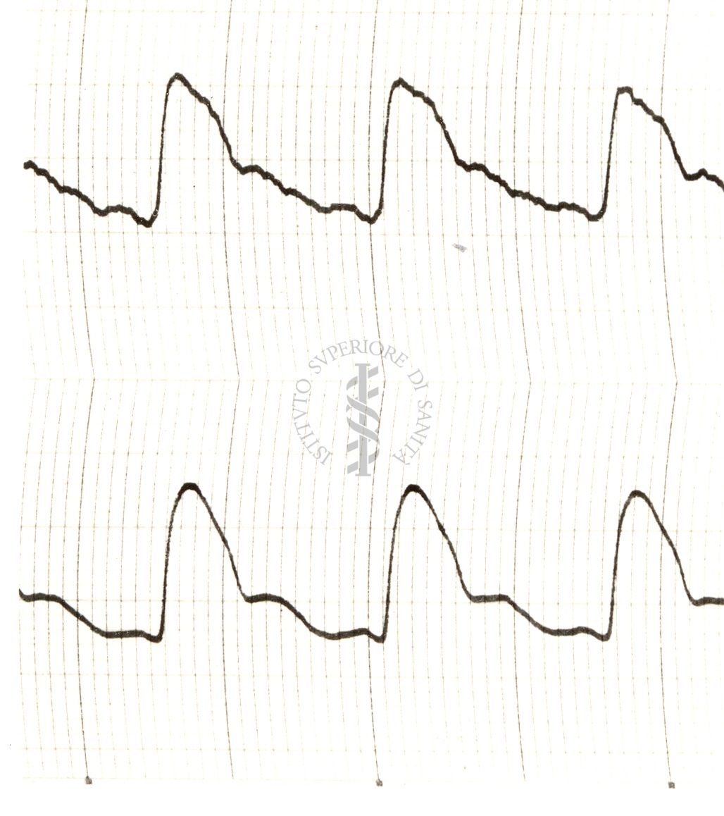 Modificazioni del piezogramma temporale nell'uomo sotto azione di istamina e di nitrito di amile