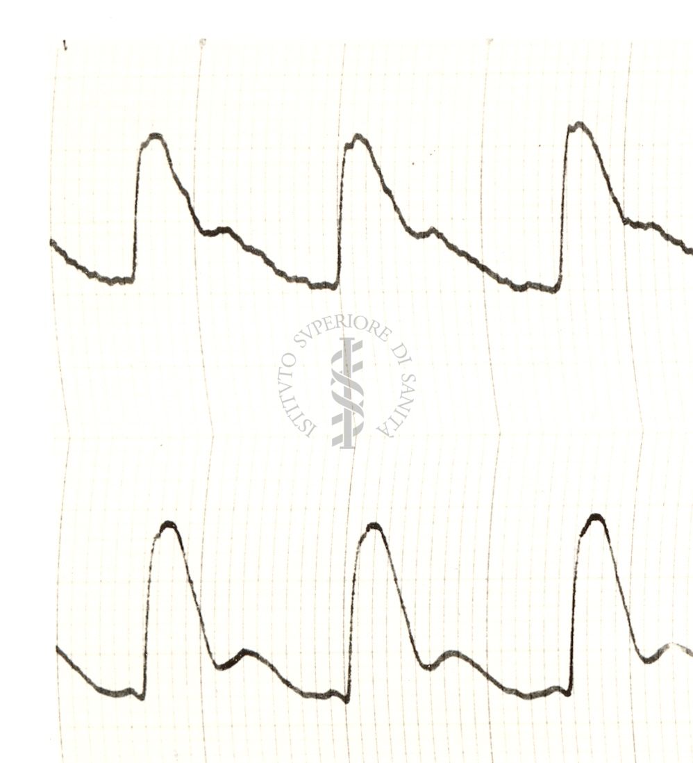 Modificazioni del piezogramma temporale nell'uomo sotto azione di istamina e di nitrito di amile