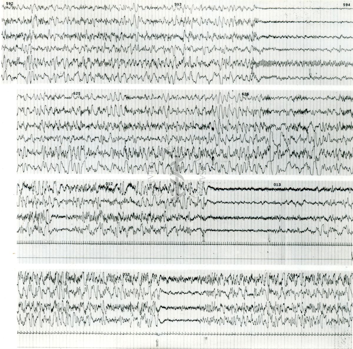 Tracciati elettroencefalografici di coniglio