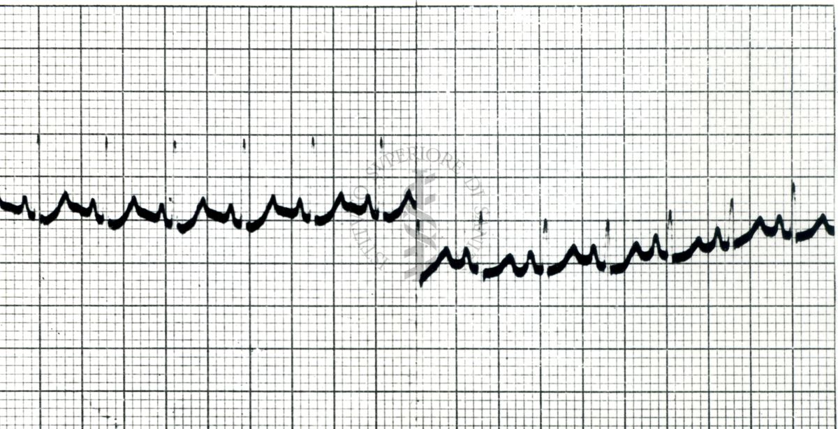 Curaro - Azione del Flaxedil su ECG del cane (2 mg/kg). 1 - ECG normale, 2 - dopo Flaxedil
