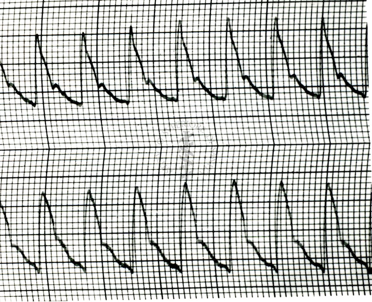 Piezosfigmogrammi di arterie temporali umane sotto attacchi emicranici