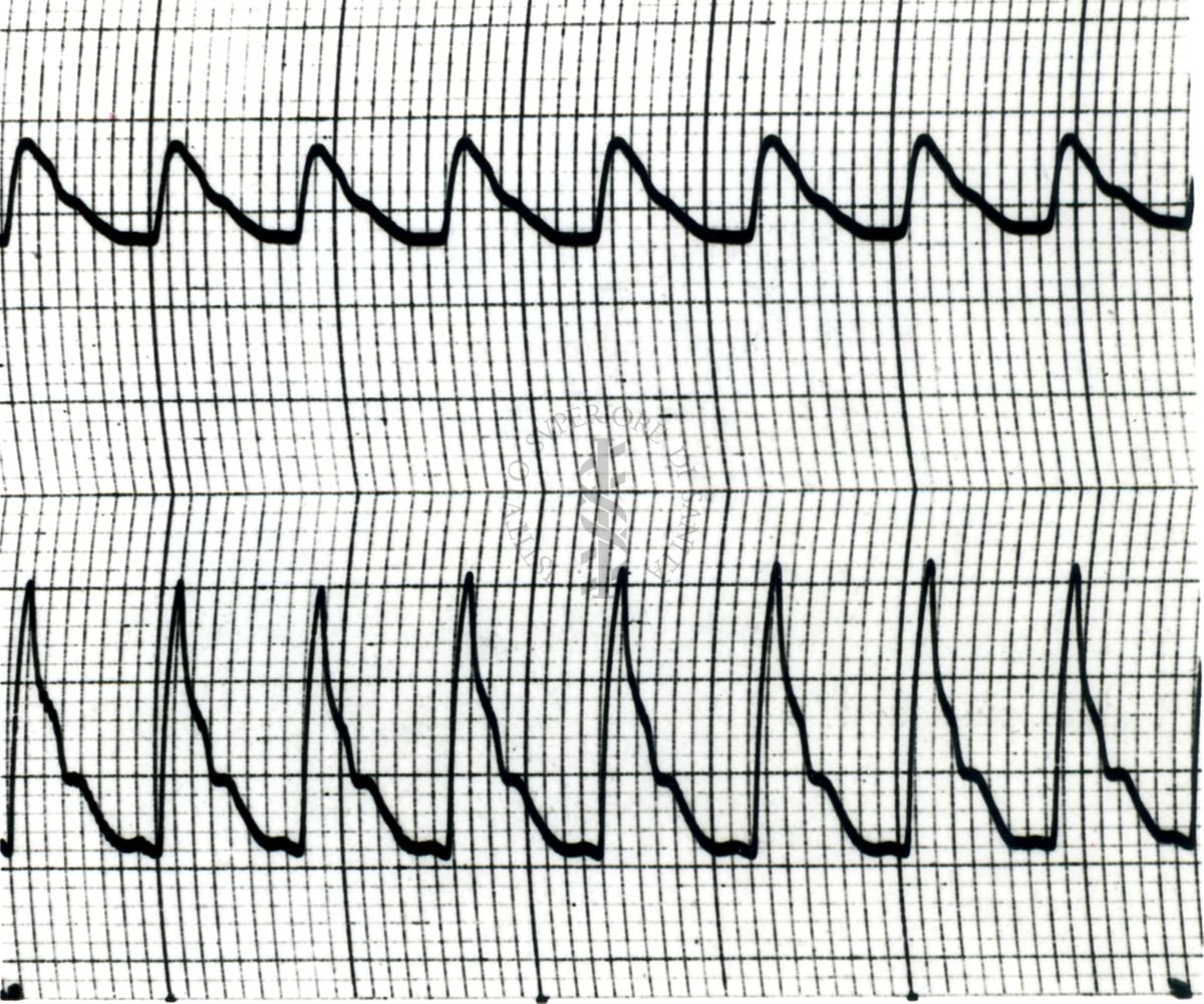 Piezosfigmogrammi di arterie temporali umane sotto attacchi emicranici