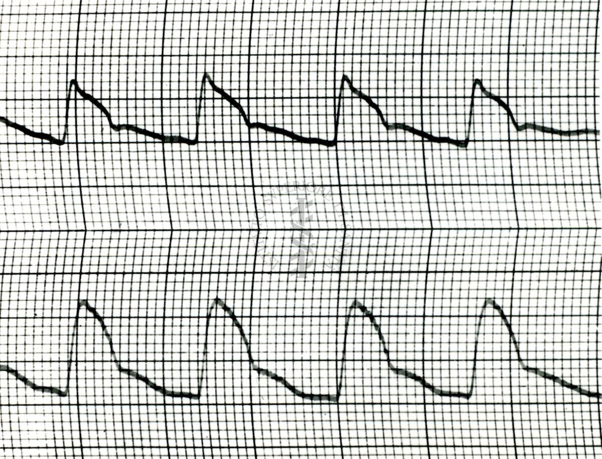 Piezosfigmogrammi di arterie temporali umane sotto attacchi emicranici