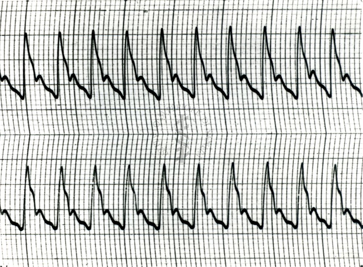 Piezosfigmogrammi di arterie temporali umane sotto attacchi emicranici