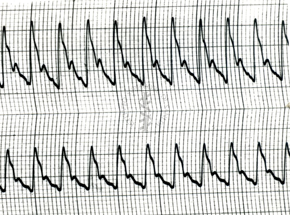 Piezosfigmogrammi di arterie temporali umane sotto attacchi emicranici