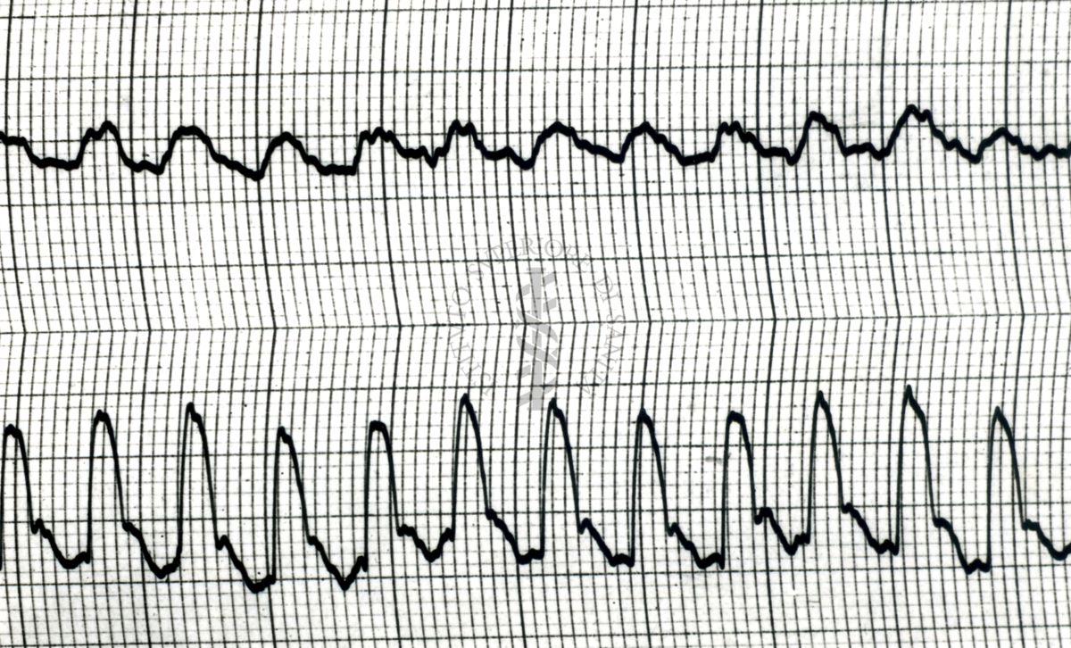 Piezosfigmogrammi di arterie temporali umane sotto attacchi emicranici