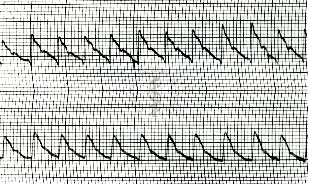 Piezosfigmogrammi di arterie temporali umane sotto attacchi emicranici