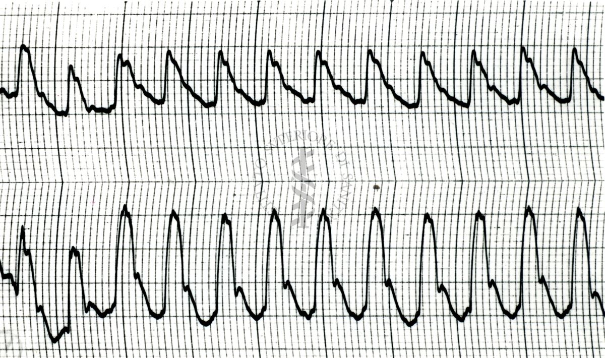 Piezosfigmogrammi di arterie temporali umane sotto attacchi emicranici