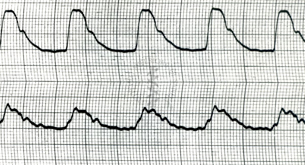 Piezosfigmogrammi di arterie temporali umane sotto attacchi emicranici