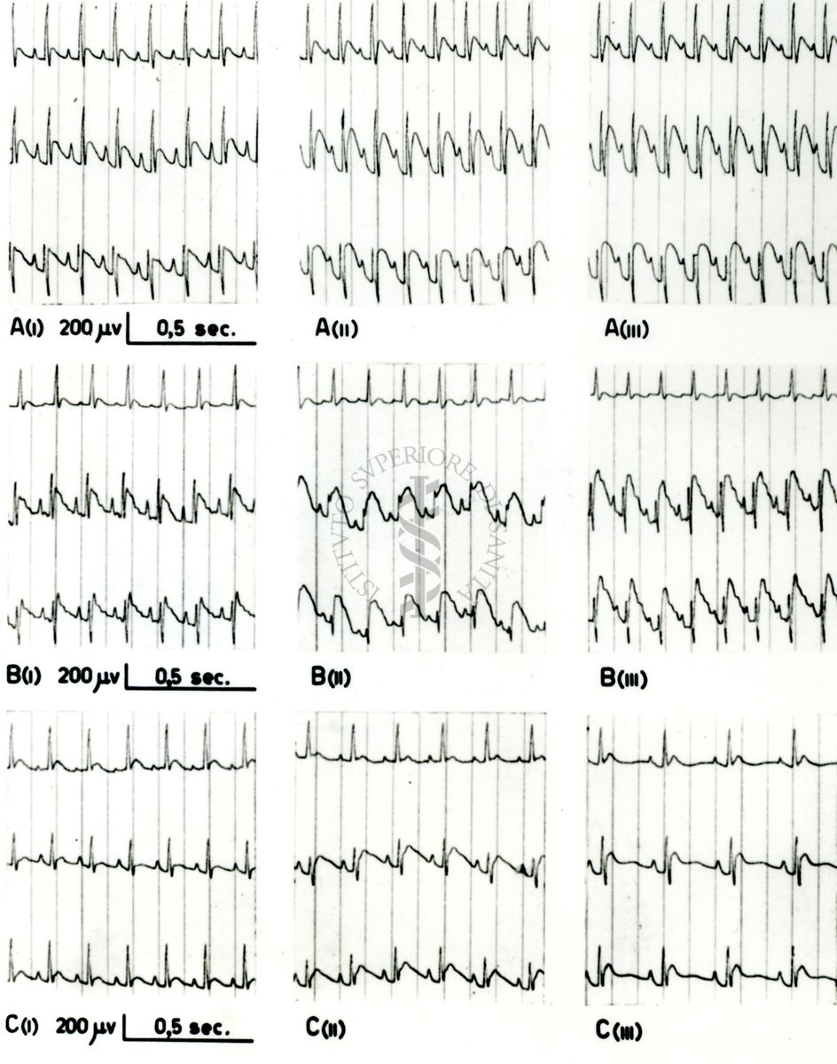 Tracciati broncografici riguardanti l'azione dell'Istamina