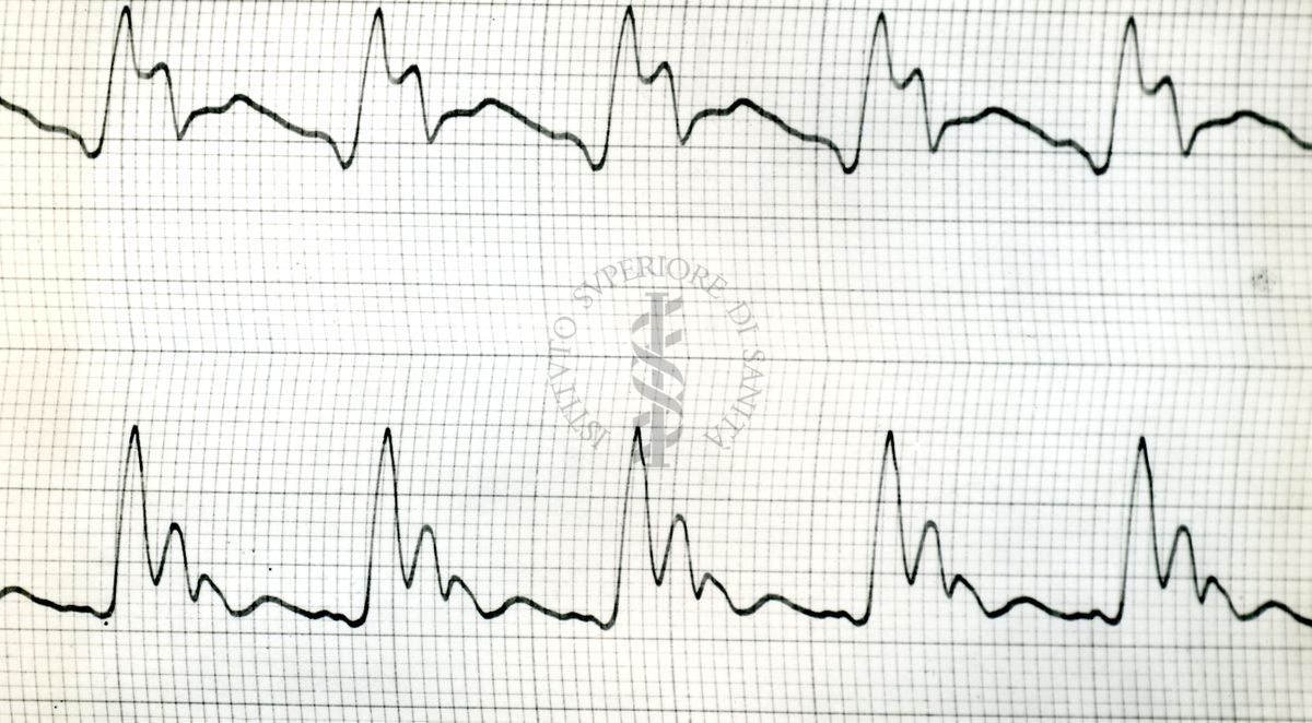 Sfigmogrammi dell'Aorta toracica