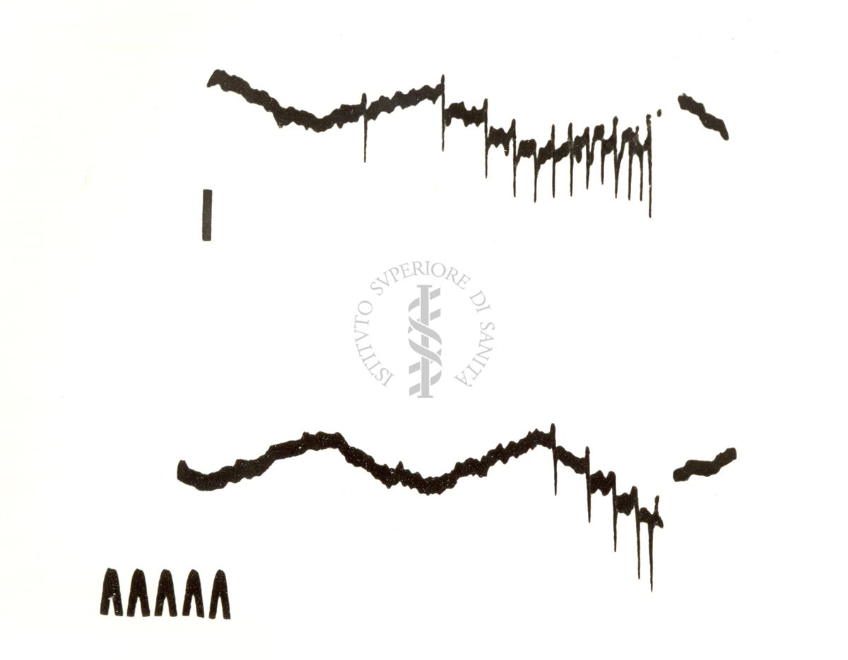 Tracciati registrati con microelettrodi da una singola cellula