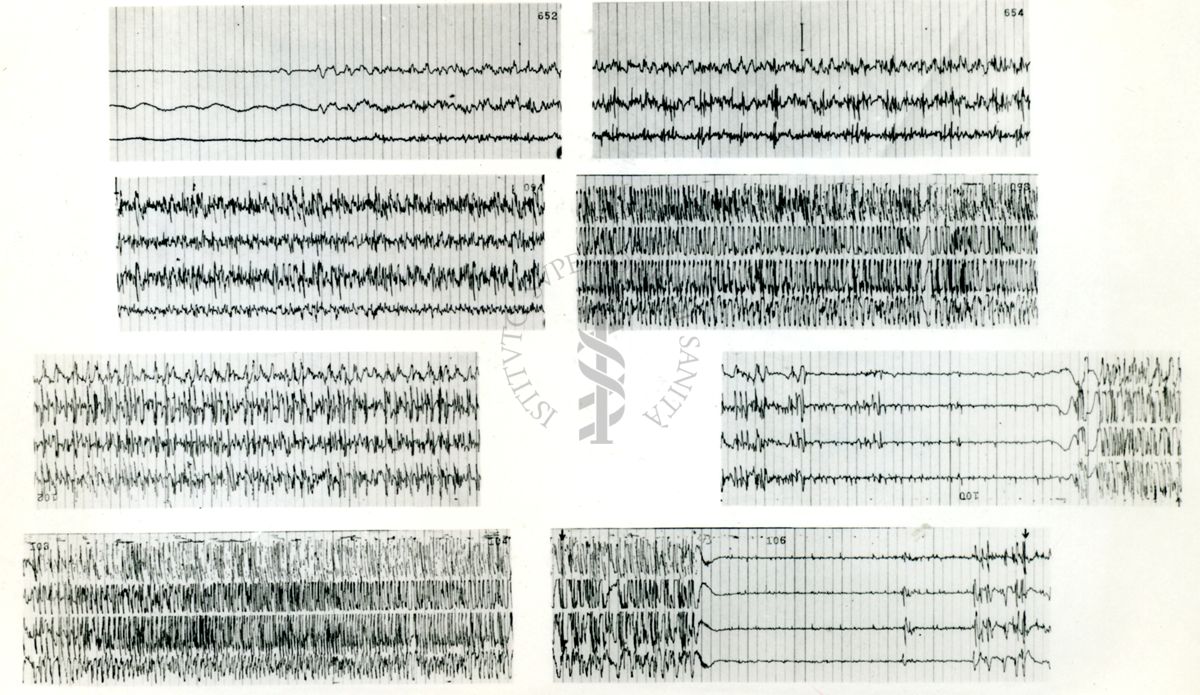 Rapporti tra circolazione cerebrale ed elettroncefalografia