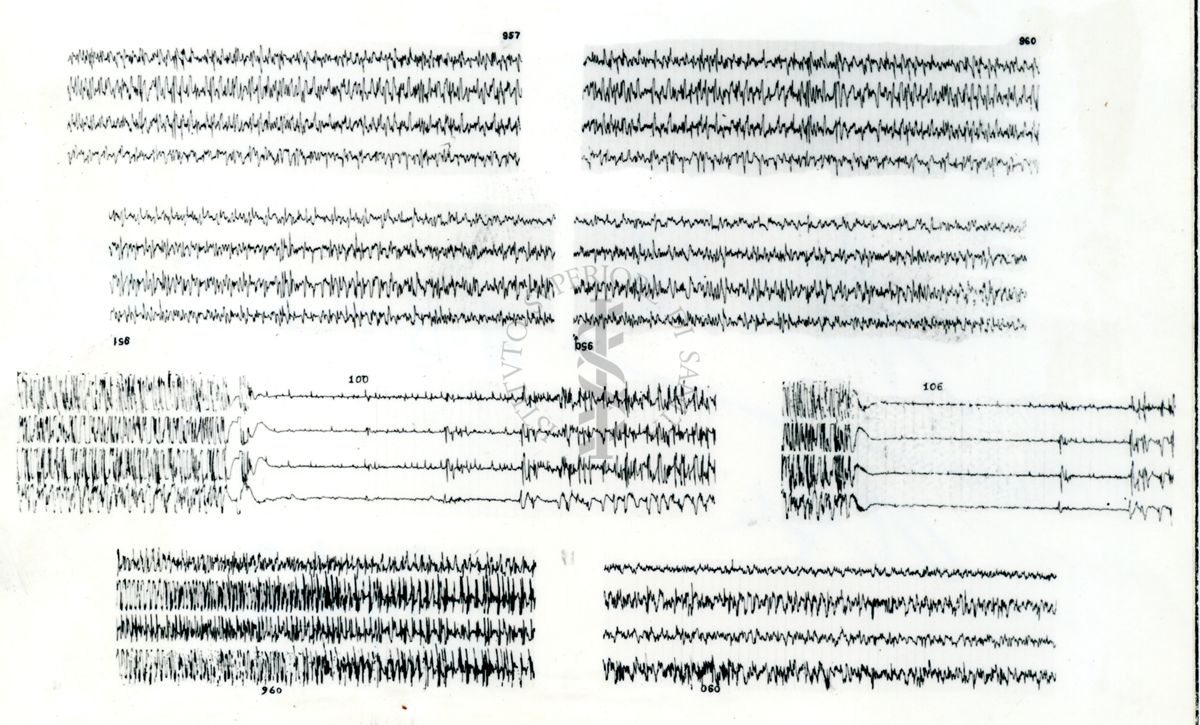 Azione elettroencefalografica della stricnina