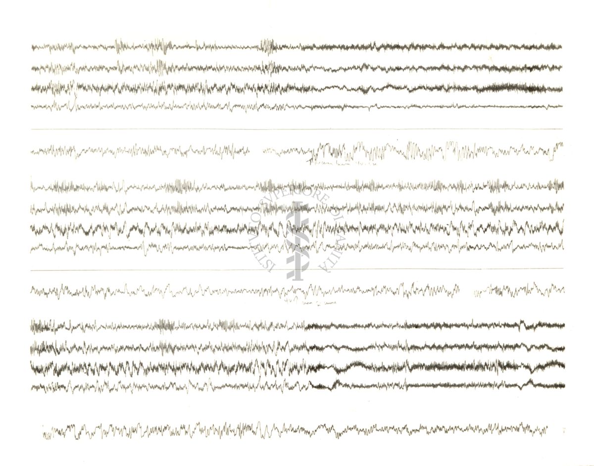 Tracciati elettroencefalografici