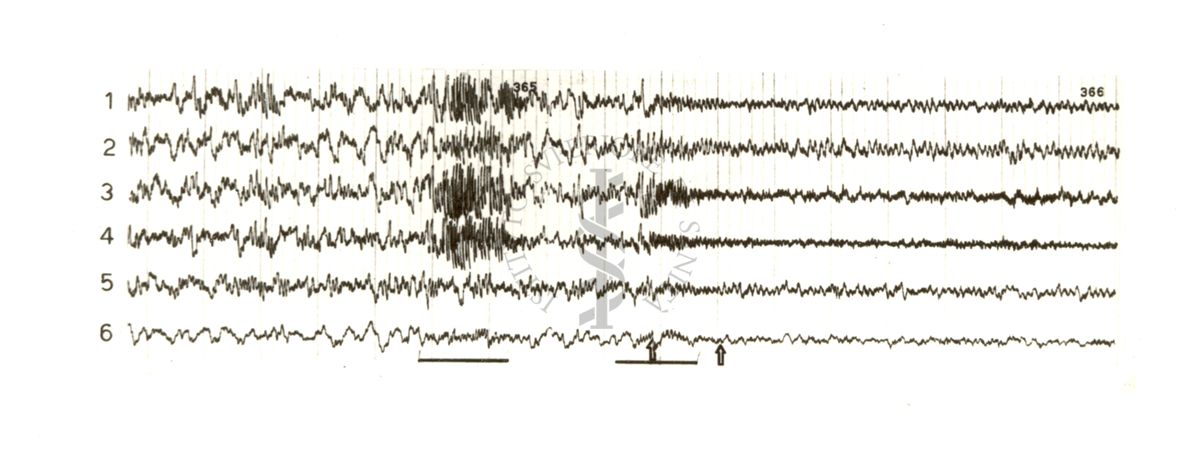 Tracciati elettroencefalografici