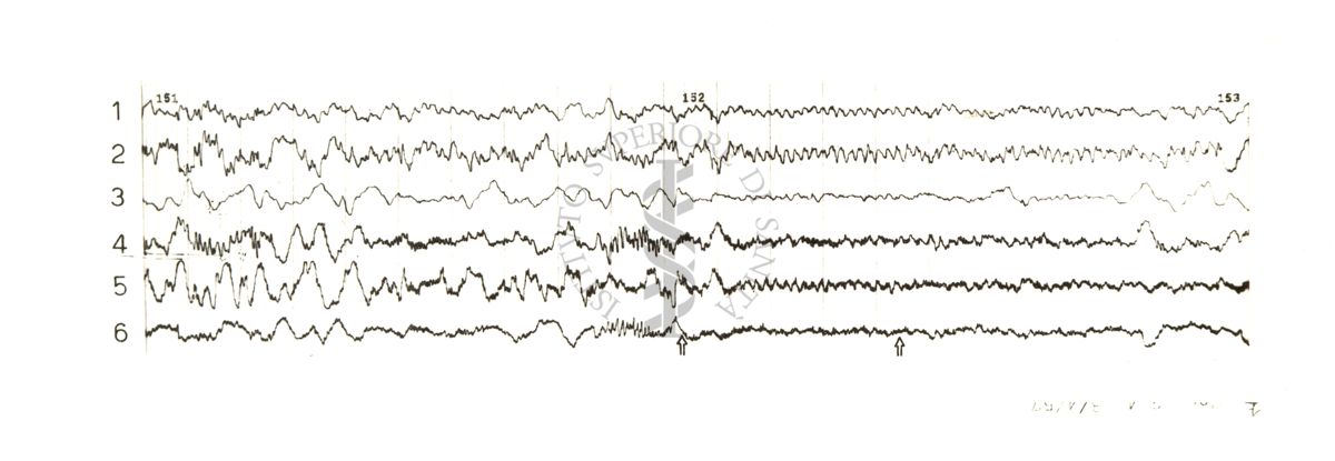 Tracciati elettroencefalografici