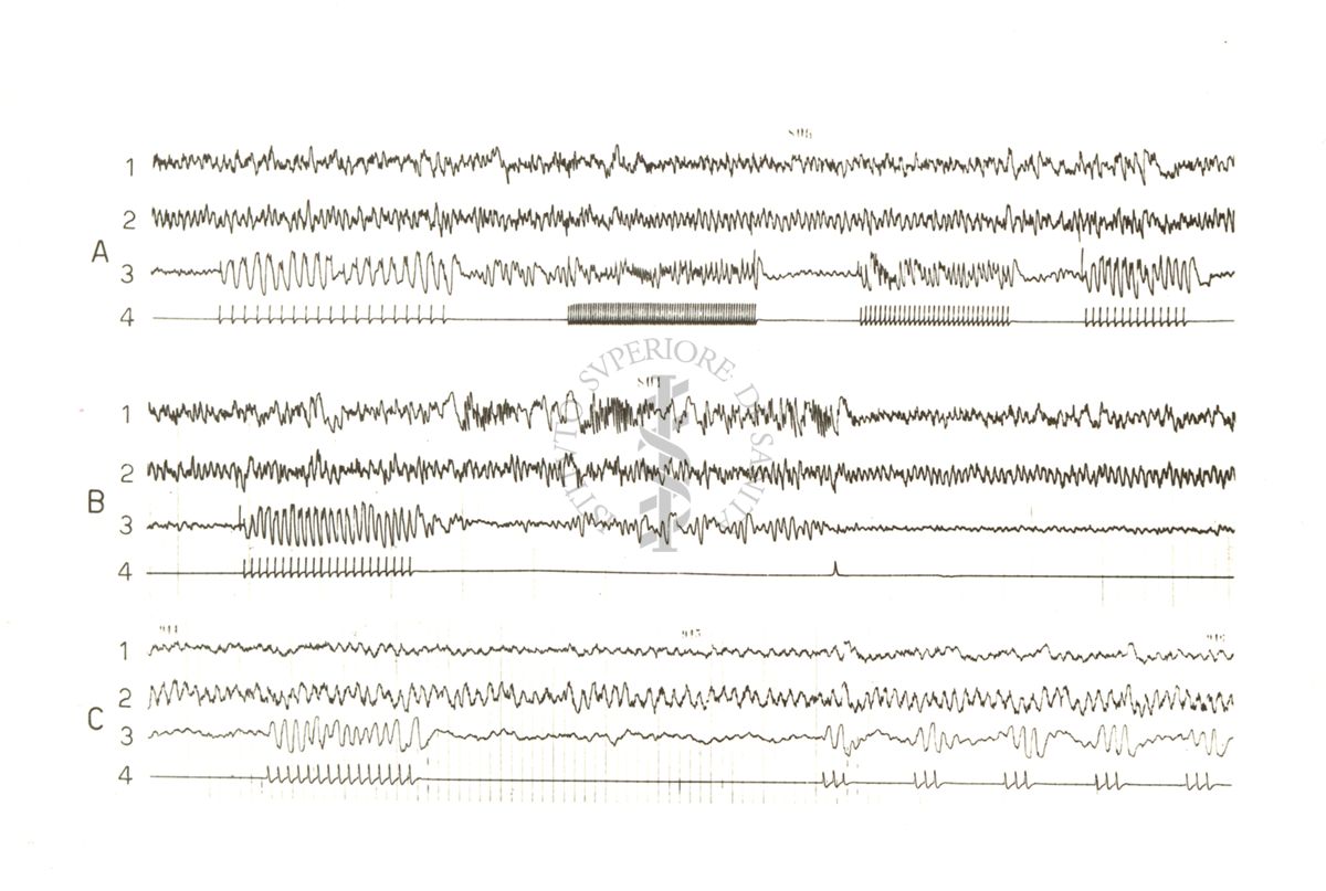 Tracciati elettroencefalografici