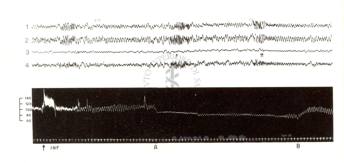 Tracciati elettroencefalografici