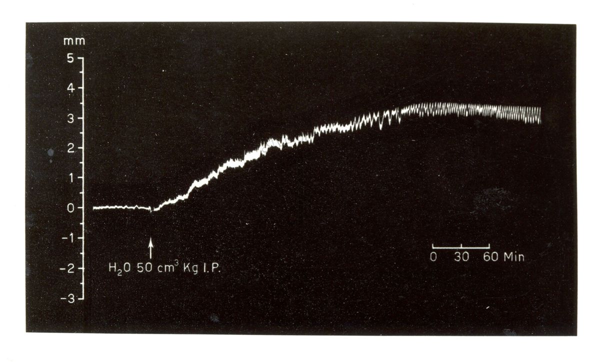 Edema cerebrale