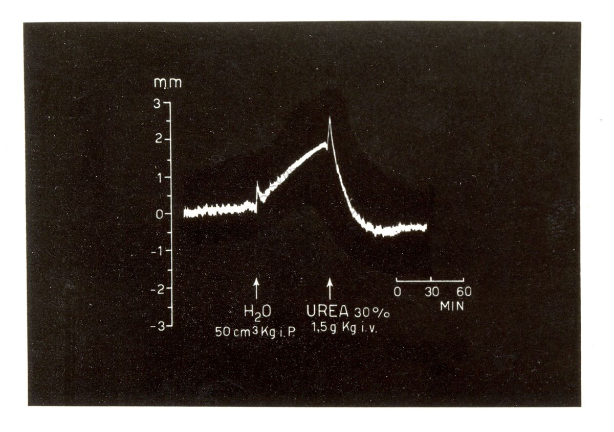 Edema cerebrale