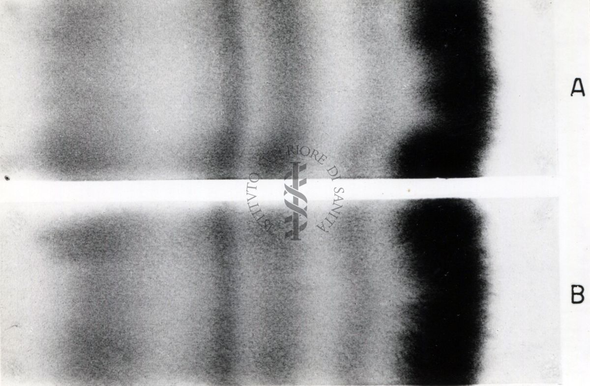 Elettroforesi su carta di sieri umani.Casi clinici trattati con raggi x.