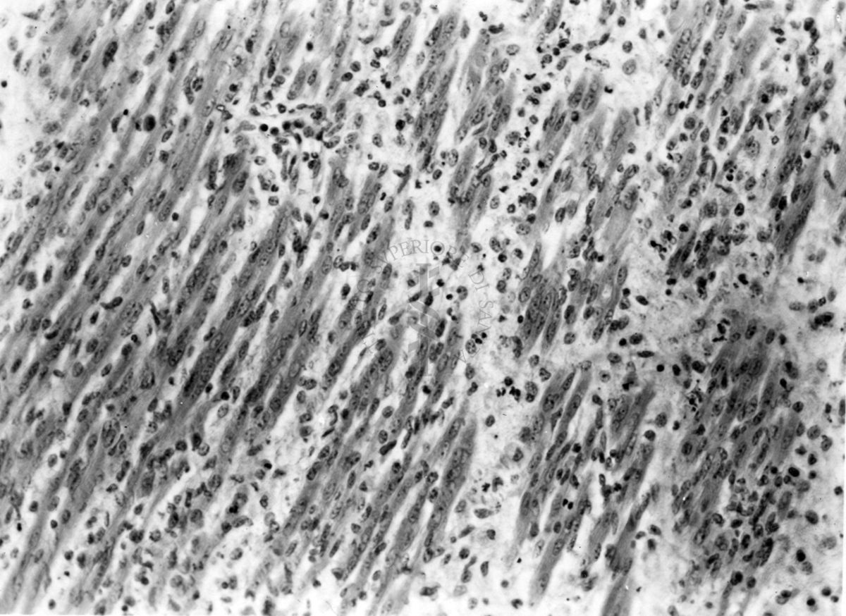 Miosite da virus Coxsackie in topino lattante. Le miositi sono un gruppo eterogeneo di malattie muscolari acquisite, accomunate dall'infiammazione del tessuto muscolare striato. Esse fanno parte del più ampio gruppo delle connettiviti , tra le cui forme rientrano le polimiosite e la dermatomiosite.