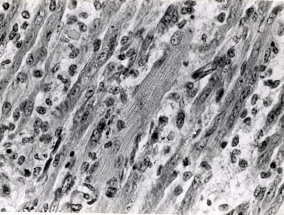 Miosite da virus Coxsackie in topino lattante. Le miositi sono un gruppo eterogeneo di malattie muscolari acquisite, accomunate dall'infiammazione del tessuto muscolare striato. Esse fanno parte del più ampio gruppo delle connettiviti , tra le cui forme rientrano le polimiosite e la dermatomiosite.