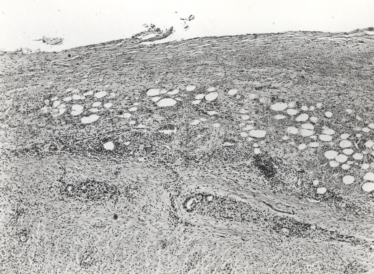 Studio istologico di una cellula argentaffine (struttura che si colora con i sali d'argento) dell'appendice