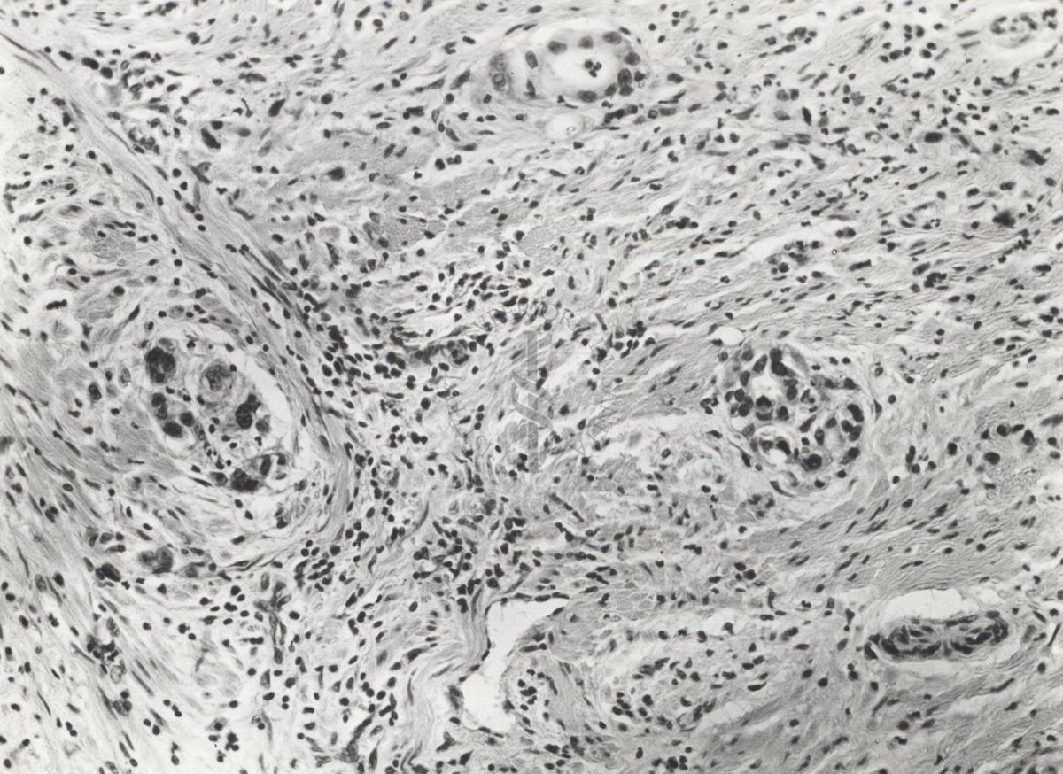 Studio istologico di una cellula argentaffine (struttura che si colora con i sali d'argento) dell'appendice