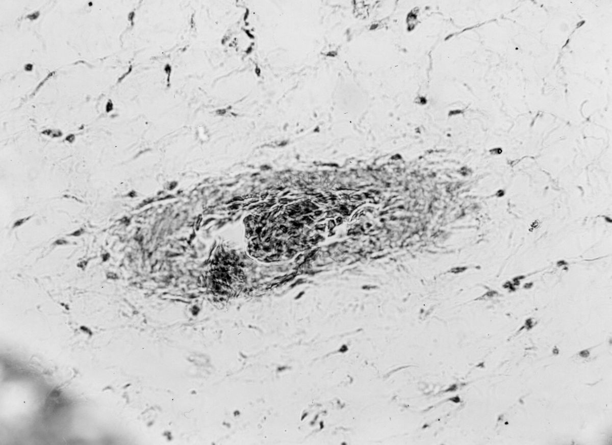 Embrioni inoculati con materiale leucemico umano con e senza filtrazioni da Scitz. Controlli relativi