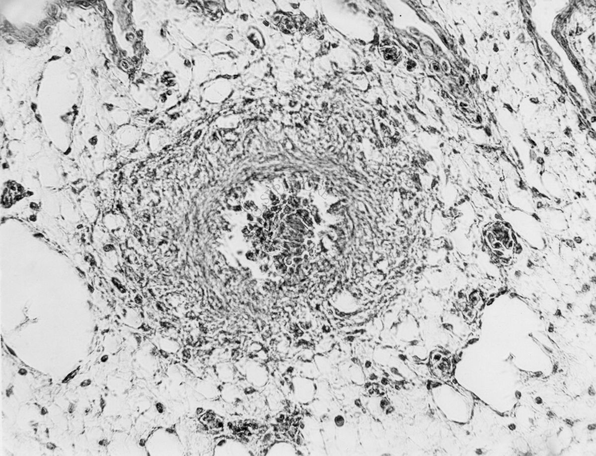 Embrioni inoculati con materiale leucemico umano con e senza filtrazioni da Scitz. Controlli relativi