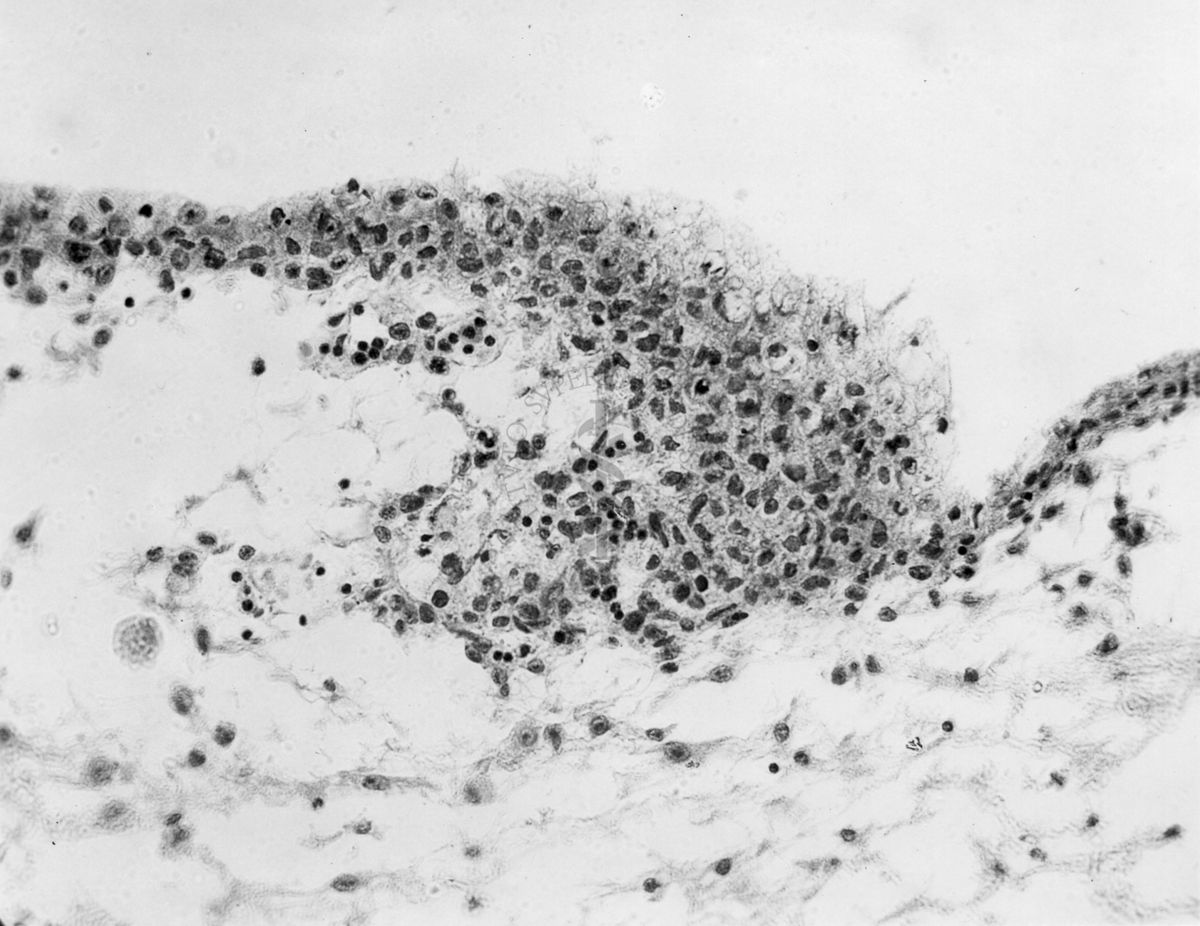 Embrioni inoculati con materiale leucemico umano con e senza filtrazioni da Scitz. Controlli relativi