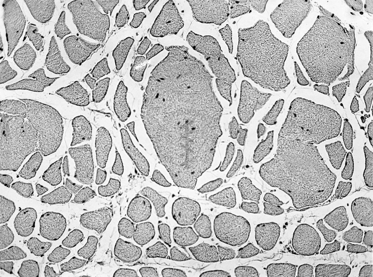 Effetto dell'ipertiroidismo sperimentale sulle alterazioni muscolari da avitaminosi nel ratto