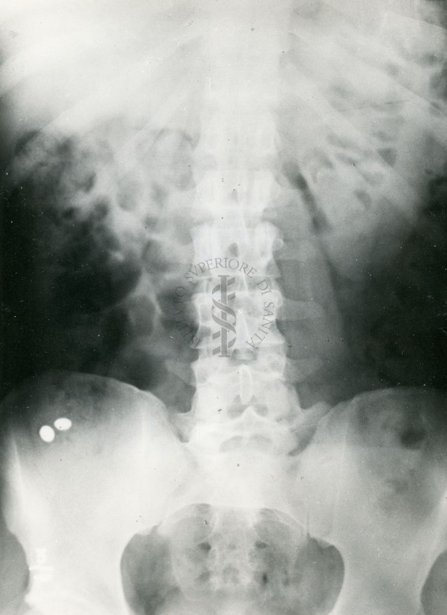 Controllo radiologico del comportamento nell'apparato digerente di compresse opache ai raggi X rivestite con vernici gastro-resistenti