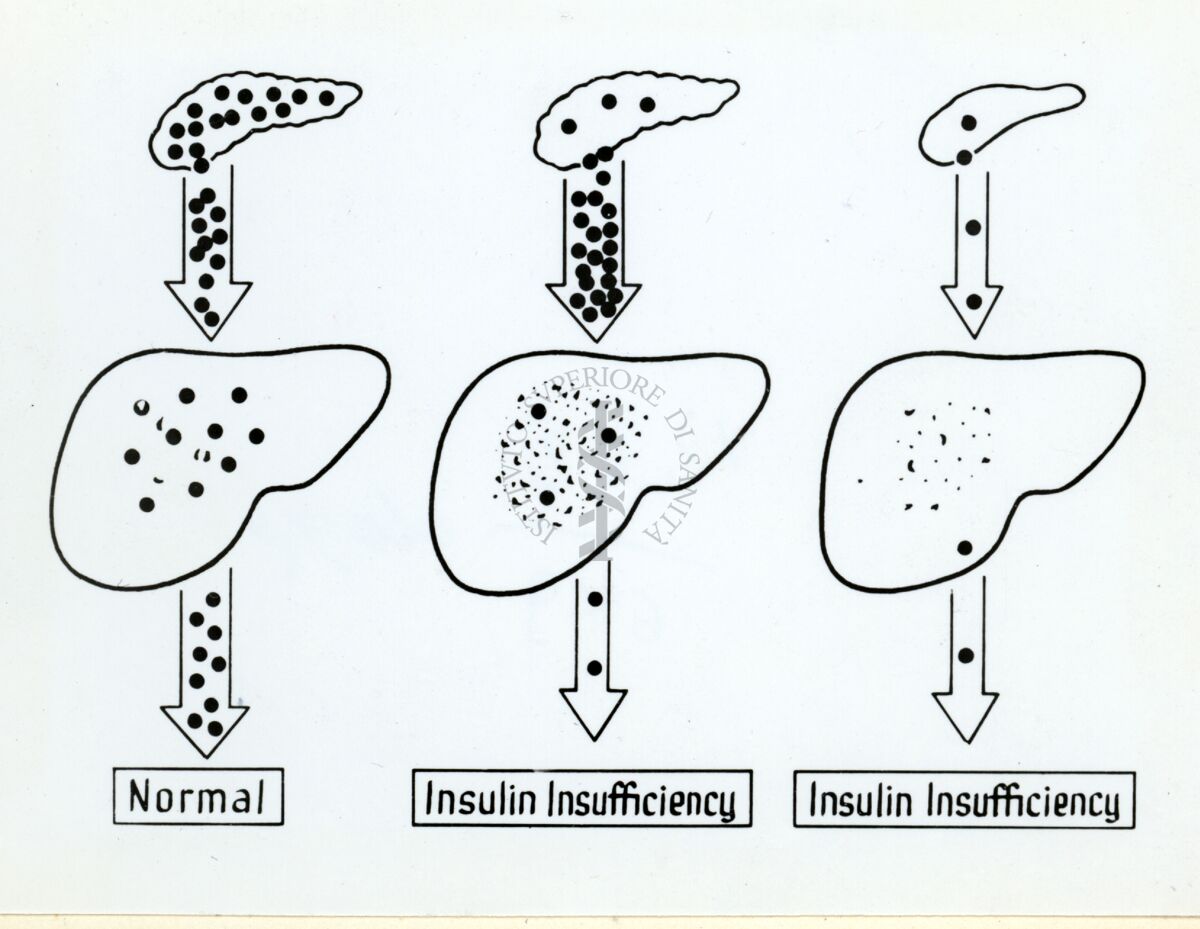 Diagramma sulla insufficienza insulinica