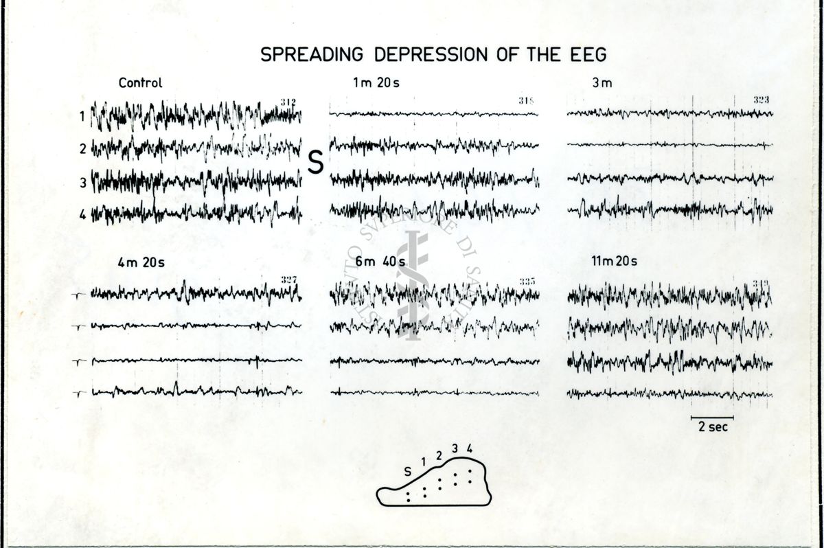 Immagine che ritrae l'andamento dell' EEG