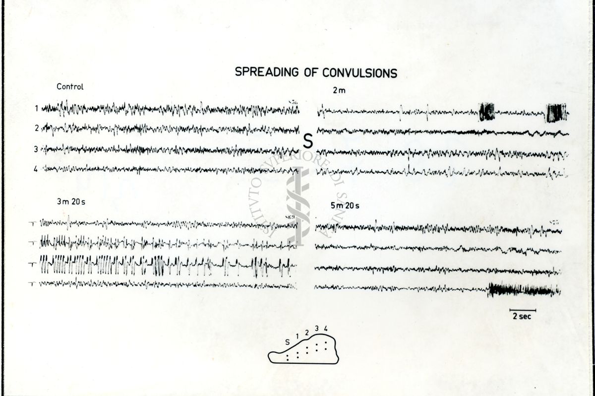 Immagine che ritrae l'andamento dell' EEG