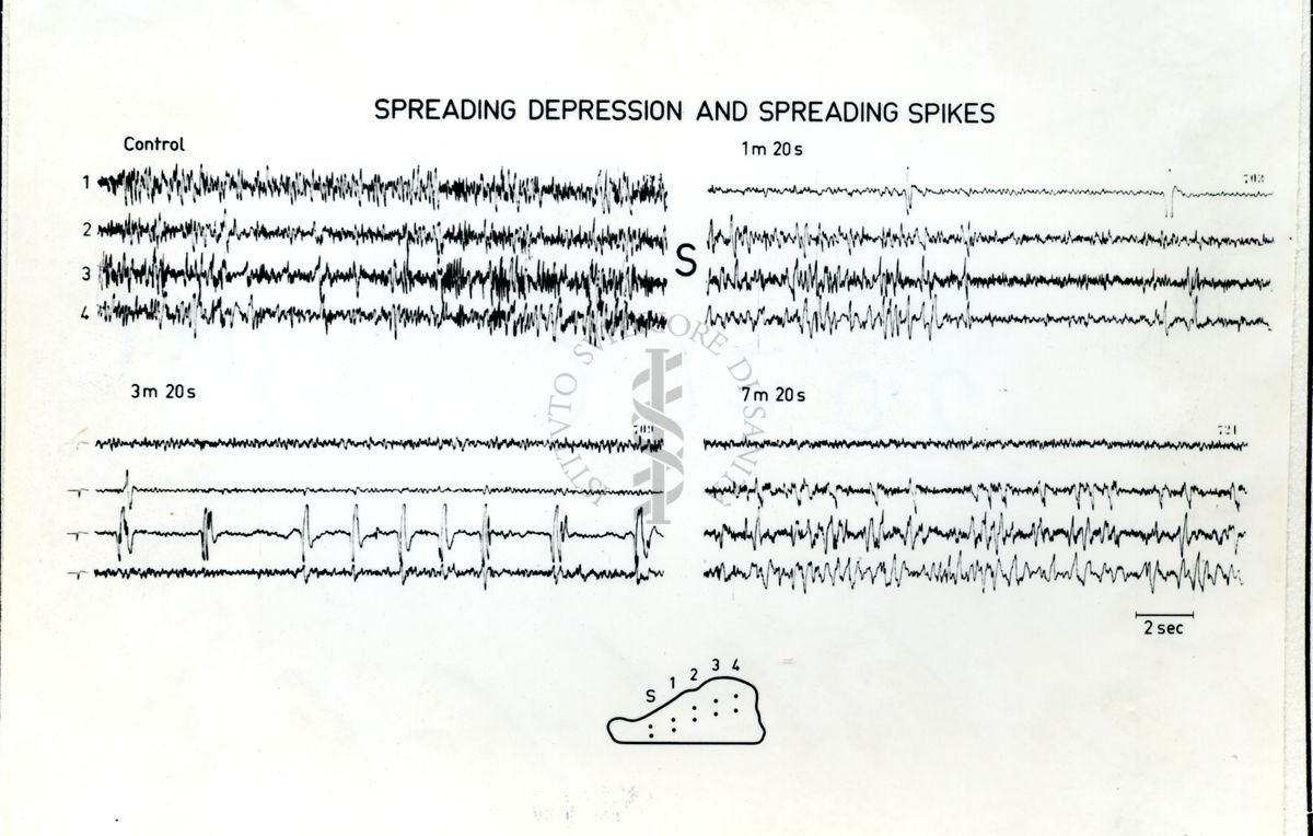 Immagine che ritrae l'andamento dell' EEG