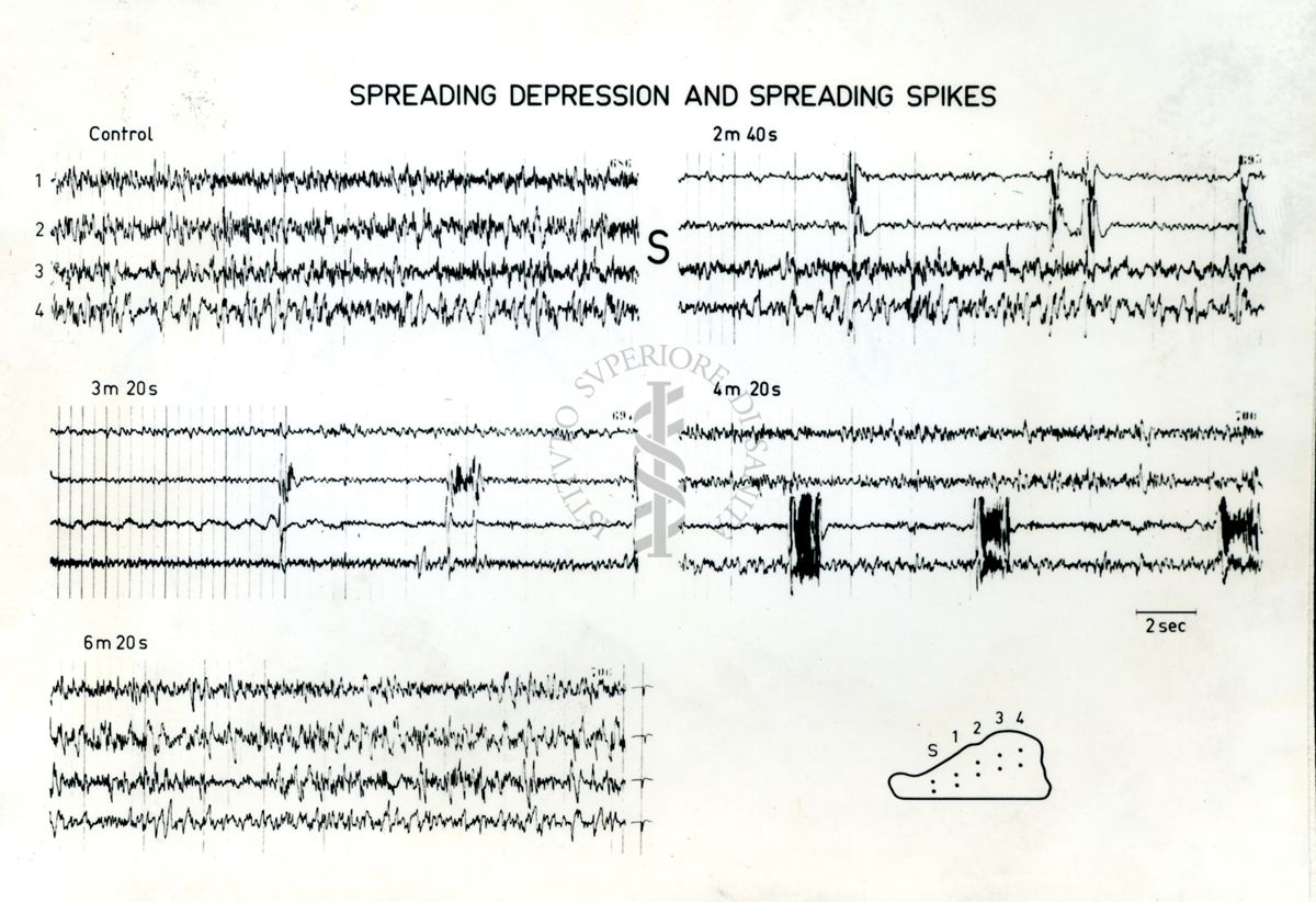 Immagine che ritrae l'andamento dell' EEG